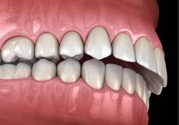 Common Problem - Overbite